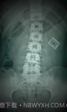 X射线扫描器胃截图3