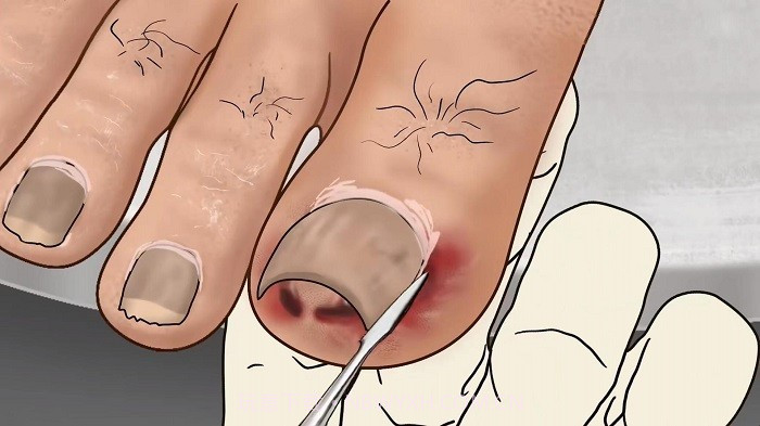 修脚足疔模拟器高画质版截图1